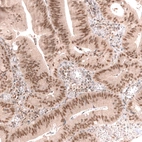 Immunohistochemical staining of human colorectal cancer shows moderate to strong nuclear positivity in tumor cells.