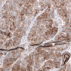 Immunohistochemical staining of human ovarian cancer (papillary carcinoma) shows strong membranous positivity in tumor cells.