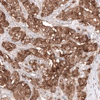 Immunohistochemical staining of human ovarian cancer (high grade serous ovarian carcinoma) shows strong membranous and cytoplasmic positivity in tumor cells.