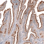 Immunohistochemical staining of human ovarian (low grade serous ovarian carcinoma) cancer shows strong membranous positivity in tumor cells.