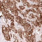 Immunohistochemical staining of human ovarian cancer (high grade serous ovarian carcinoma) shows strong membranous and cytoplasmic positivity in tumor cells.