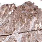 Immunohistochemical staining of human ovarian cancer (papillary carcinoma) shows strong membranous positivity in tumor cells.