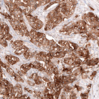 Immunohistochemical staining of human ovarian cancer (high grade serous ovarian carcinoma) shows strong membranous and cytoplasmic positivity in tumor cells.