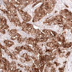 Immunohistochemical staining of human ovarian cancer (high grade serous ovarian carcinoma) shows strong membranous and cytoplasmic positivity in tumor cells.