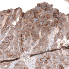 Immunohistochemical staining of human ovarian cancer (papillary carcinoma) shows strong membranous positivity in tumor cells.