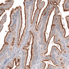 Immunohistochemical staining of human ovarian cancer (low grade serous ovarian carcinoma) shows strong membranous positivity in tumor cells.