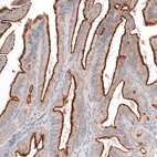 Immunohistochemical staining of human ovarian cancer (low grade serous ovarian carcinoma) shows strong membranous positivity in tumor cells.