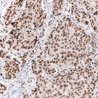 Immunohistochemical staining of human breast cancer (ductal carcinoma) shows strong nuclear positivity in tumor cells.
