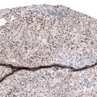 Immunohistochemical staining of human endometrial cancer shows moderate nuclear positivity in tumor cells.