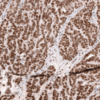 Immunohistochemical staining of human ovarian cancer 8papillary carcinoma) shows strong nuclear positivity in tumor cells.