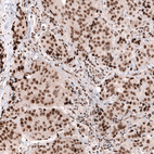 Immunohistochemical staining of human breast cancer (ductal carcinoma) shows strong nuclear positivity in tumor cells.