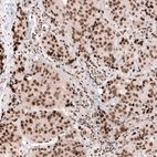 Immunohistochemical staining of human breast cancer (ductal carcinoma) shows strong nuclear positivity in tumor cells.