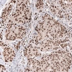 Immunohistochemical staining of human breast cancer (ductal carcinoma) shows strong nuclear positivity in tumor cells.