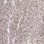 Immunohistochemical staining of human ovarian cancer (high grade serous carcinoma) shows moderate to strong nuclear positivity in tumor cells.