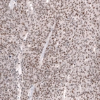 Immunohistochemical staining of human ovarian cancer (high grade serous carcinoma) shows moderate to strong nuclear positivity in tumor cells.
