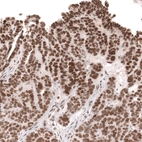 Immunohistochemical staining of human ovarian cancer (papillary carcinoma) shows moderate to strong nuclear positivity in tumor cells.