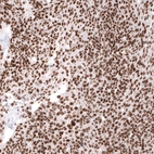 Immunohistochemical staining of human ovarian cancer (high grade serous carcinoma) shows strong nuclear positivity in tumor cells.