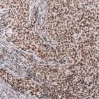 Immunohistochemical staining of human endometrial cancer shows strong nuclear positivity in tumor cells.
