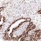 Immunohistochemical staining of human ovarian cancer (papillary carcinoma) shows strong nuclear positivity in tumor cells.