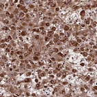 Immunohistochemical staining of human Placenta shows strong cytoplasmic positivity in decidual cells.