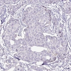 Immunohistochemical staining of human HER2-negative breast cancer shows no positivity in tumor cells, as expected.