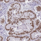 Immunohistochemical staining of human colorectal cancer shows moderate to strong nuclear positivity in tumor cells.