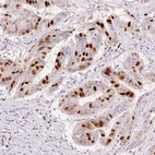 Immunohistochemical staining of human colorectal cancer shows moderate to strong nuclear positivity in a subset of tumor cells.