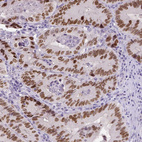 Immunohistochemical staining of human colorectal cancer shows moderate to strong nuclear positivity in tumor cells.