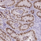 Immunohistochemical staining of human colorectal cancer shows moderate to strong nuclear positivity in tumor cells.