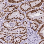 Immunohistochemical staining of human colorectal cancer shows strong nuclear positivity in tumor cells.
