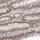 Immunohistochemical staining of human colorectal cancer shows strong nuclear positivity in glandular cells.