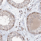 Immunohistochemical staining of human testis shows strong nuclear positivity in Leydig cells.