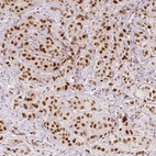 Immunohistochemical staining of human breast cancer shows moderate to strong nuclear positivity in tumor cells.