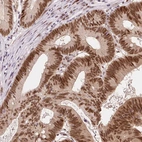 Immunohistochemical staining of human colorectal cancer shows strong nuclear positivity in tumor cells.