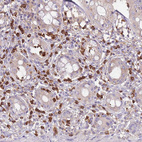 Immunohistochemical staining of human rectum shows strong cytoplasmic positivity in mast cell.