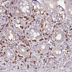 Immunohistochemical staining of human rectum shows strong cytoplasmic positivity in mast cell.