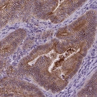 Immunohistochemical staining of human colorectal cancer shows moderate to strong membranous positivity in tumor cells.