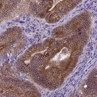 Immunohistochemical staining of human colorectal cancer shows strong membranous positivity in tumor cells.