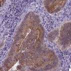 Immunohistochemical staining of human colorectal cancer shows strong membranous positivity in tumor cells.