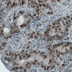 Immunohistochemical staining of stomach cancer shows nuclear and nucleolar immunoreactivity in tumor cells.