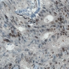 Immunohistochemical staining of human colorectal cancer shows positivity in a subset of tumor cells.