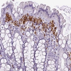 Immunohistochemical staining of human colon shows strong cytoplasmic positivity in lymphoid cells.