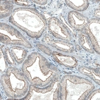Immunohistochemical staining of human prostate cancer shows strong apical membrane positivity in tumor cells.