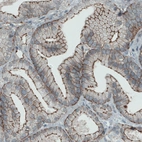 Immunohistochemical staining of human prostate cancer shows membranous positivity in tumor cells.