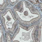 Immunohistochemical staining of human prostate cancer shows membranous positivity in tumor cells.