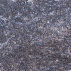 Immunohistochemical staining of human chronic lymphocytic leukemia shows moderate nuclear positivity in tumor cells.