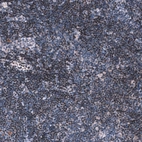 Immunohistochemical staining of human chronic lymphocytic leukemia shows moderate nuclear positivity in tumor cells.