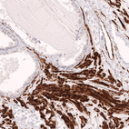 Immunohistochemical staining of human prostate shows strong cytoplasmic positivity in smooth muscle cells.