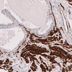 Immunohistochemical staining of human prostate shows strong cytoplasmic positivity in smooth muscle cells.