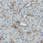 Immunohistochemical staining of human liver cancer shows positivity in the sinusoids.